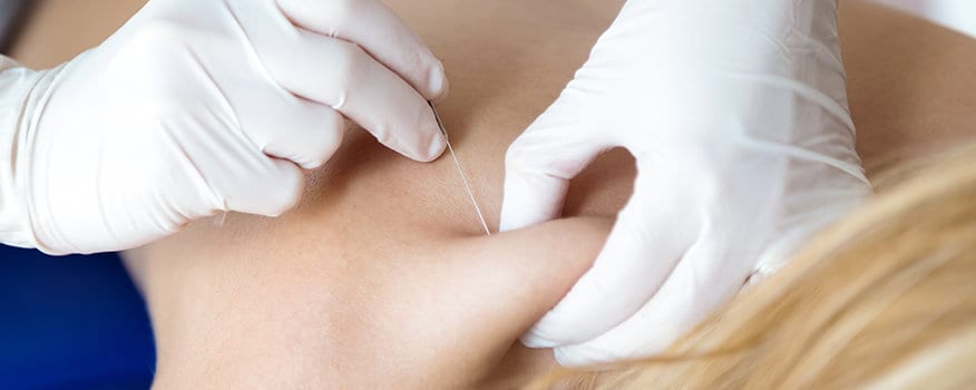 Trigger Point Injections